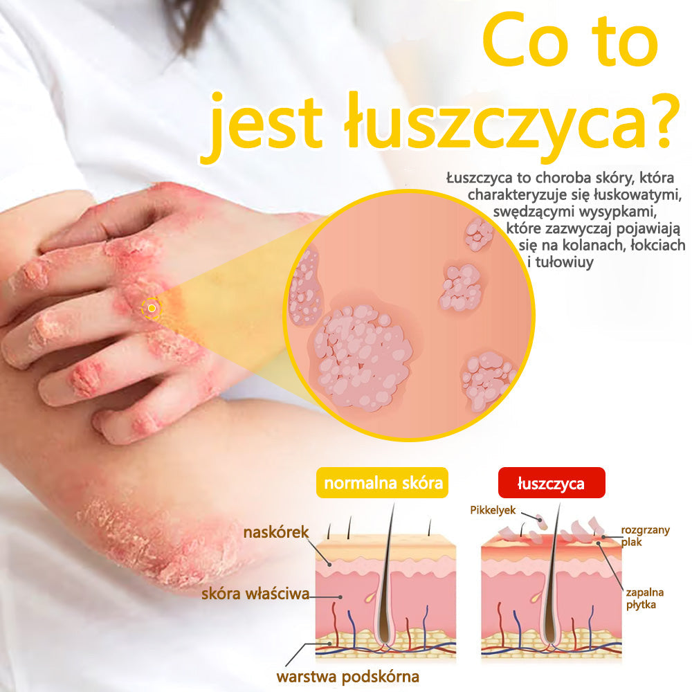 ✅flysmus™ Krem Leczniczy z Jadem Pszczelim🐝: Leczenie egzemy, łuszczycy, trądziku, trądziku różowatego, infekcji grzybiczych, brodawek