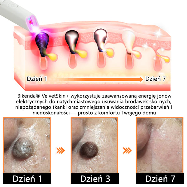 ✨ Bikenda® – Laserowy Długopis CO₂ do Usuwania 🟤 Znamion, 🦠 Brodawek, 🔘 Przebarwień i Innych Niedoskonałości Skóry