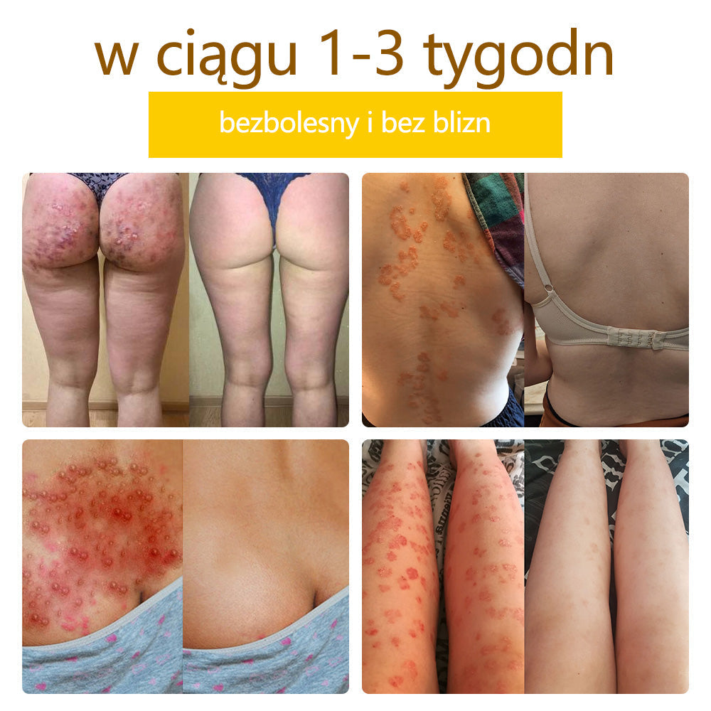 ✅flysmus™ Krem Leczniczy z Jadem Pszczelim🐝: Leczenie egzemy, łuszczycy, trądziku, trądziku różowatego, infekcji grzybiczych, brodawek