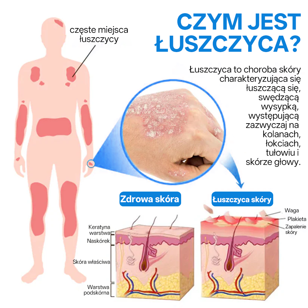 ✅ Oficjalny Sklep: Zvoevo® Magnezowy Ziołowy Spray na Łuszczycę ⚕️ Certyfikowany przez FDA (Łagodzi łuszczycę i egzemę, poprawia infekcje bakteryjne w okolicach intymnych, leczy trądzik i brodawki, łagodzi ból stawów i ból neuropatyczny)