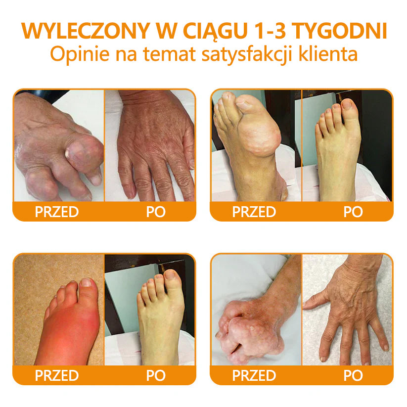 ✅Oficjalny sklep: flysmus™ Lidocaine Szybko działający środek przeciwbólowy i leczniczy 👨⚕️Zatwierdzony przez Polskie Towarzystwo Ortopedyczne (PTG) (łagodzi ból stawów, obrzęki, sztywność, zaczerwienienia, ciepło, bolesność i zmęczenie stawów)