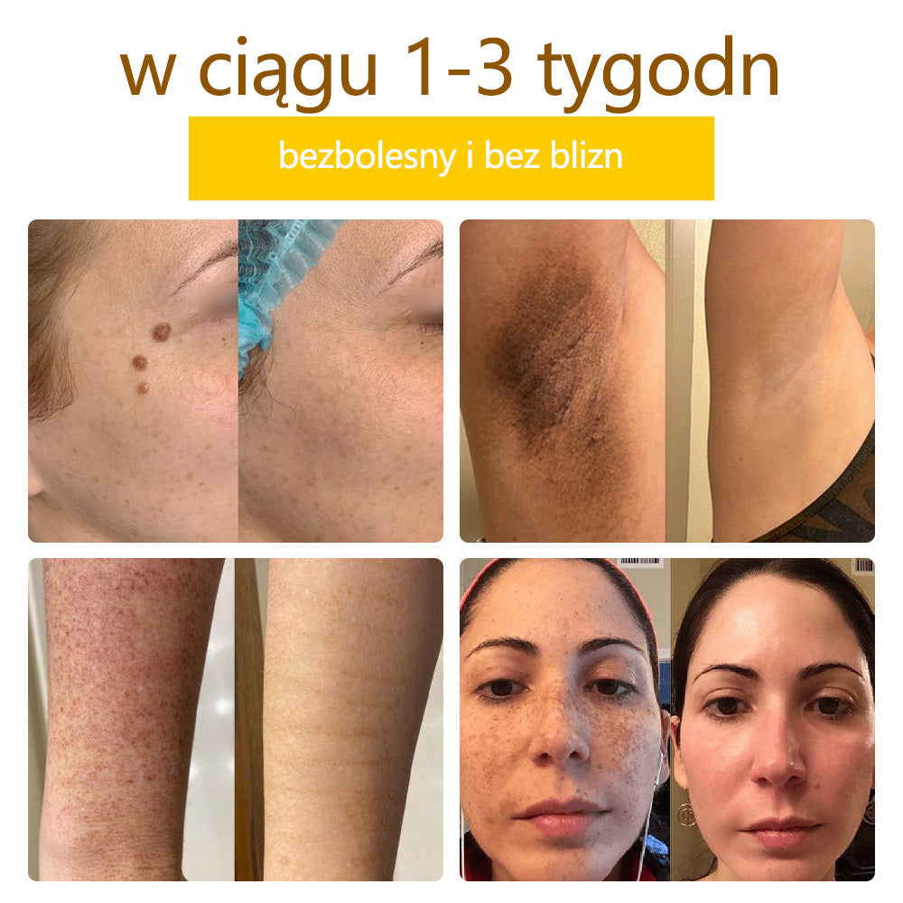 ✅flysmus™ Krem Leczniczy z Jadem Pszczelim🐝: Leczenie egzemy, łuszczycy, trądziku, trądziku różowatego, infekcji grzybiczych, brodawek