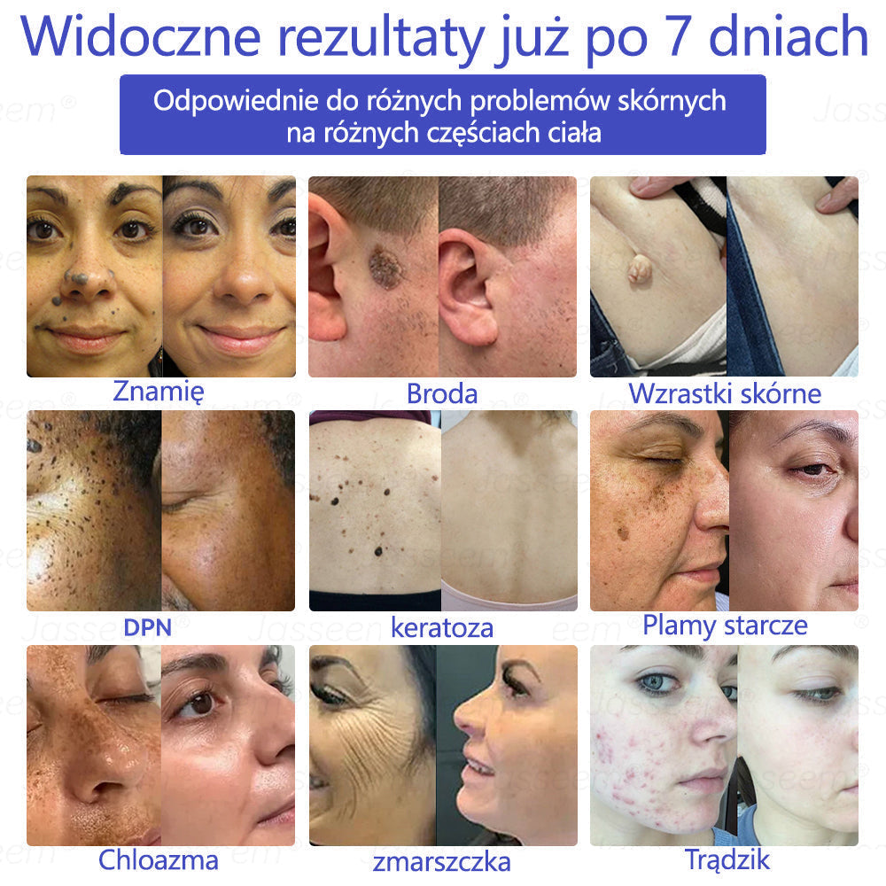 SIE𝖭𝖮𝖵𝖠™ Zaawansowany nieinwazyjny laser CO₂ do naprawy skóry 🎉 (Delikatnie usuwa brodawki, znamiona, plamy starcze i narośla skórne – bez bólu, bez zamieszania!)