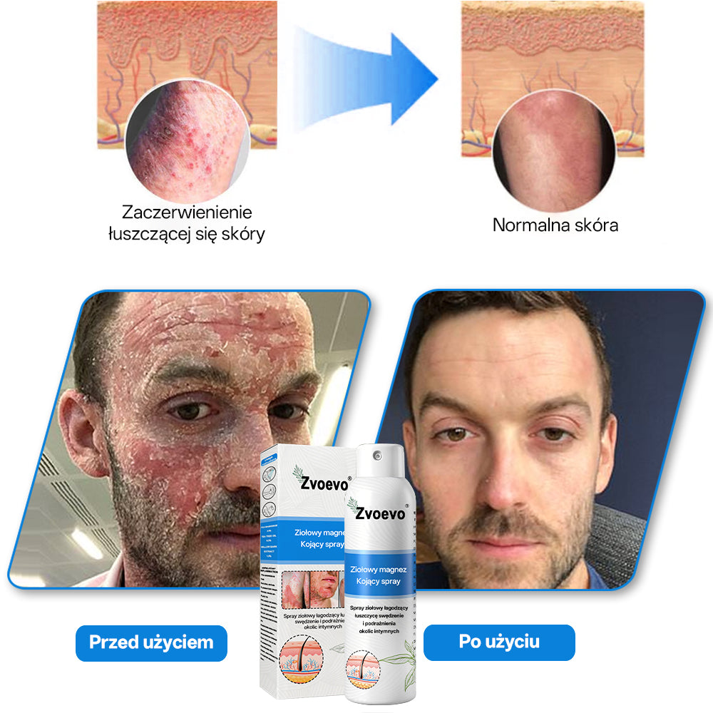 ✅ Oficjalny Sklep: Zvoevo® Magnezowy Ziołowy Spray na Łuszczycę ⚕️ Certyfikowany przez FDA (Łagodzi łuszczycę i egzemę, poprawia infekcje bakteryjne w okolicach intymnych, leczy trądzik i brodawki, łagodzi ból stawów i ból neuropatyczny)