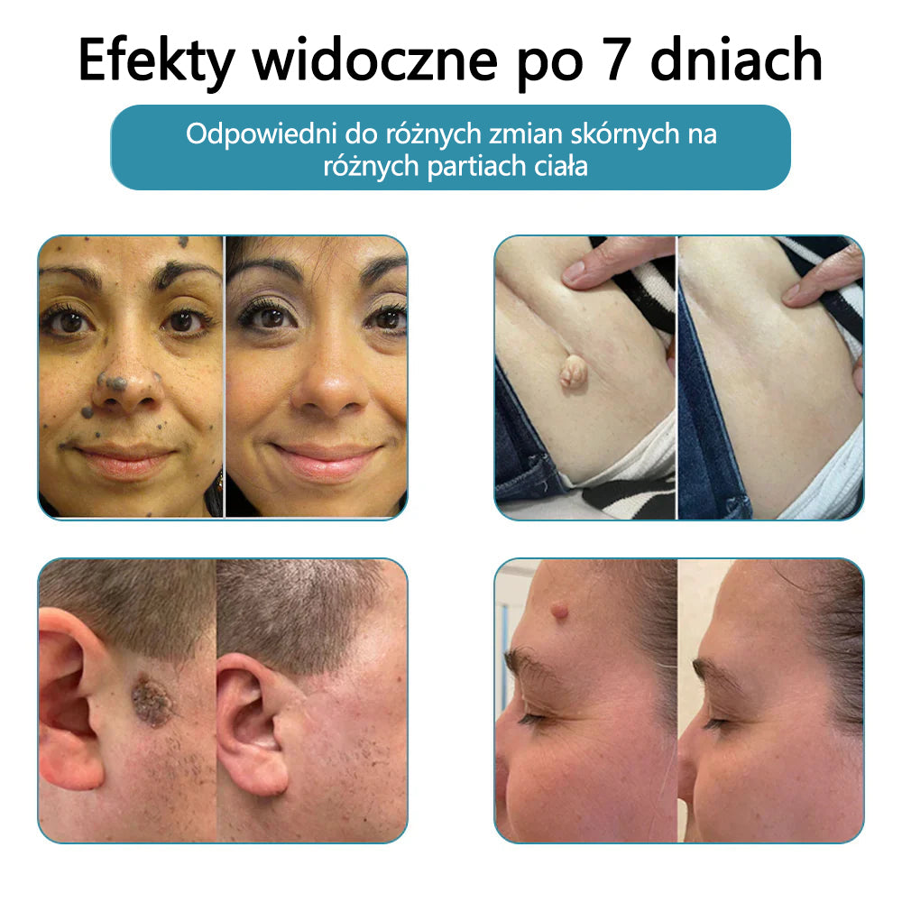 ✨ Bikenda® – Laserowy Długopis CO₂ do Usuwania 🟤 Znamion, 🦠 Brodawek, 🔘 Przebarwień i Innych Niedoskonałości Skóry