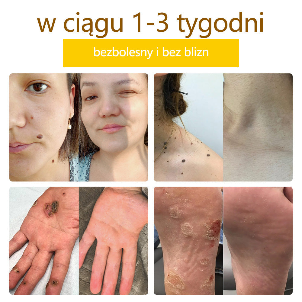 ✅flysmus™ Krem Leczniczy z Jadem Pszczelim🐝: Leczenie egzemy, łuszczycy, trądziku, trądziku różowatego, infekcji grzybiczych, brodawek