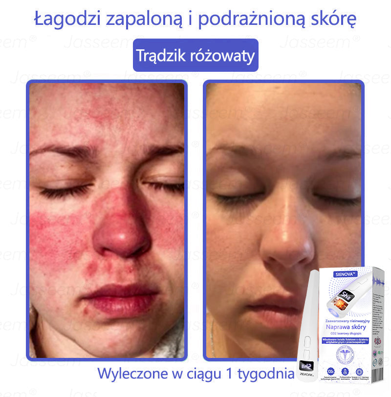 SIE𝖭𝖮𝖵𝖠™ Zaawansowany nieinwazyjny laser CO₂ do naprawy skóry 🎉 (Delikatnie usuwa brodawki, znamiona, plamy starcze i narośla skórne – bez bólu, bez zamieszania!)