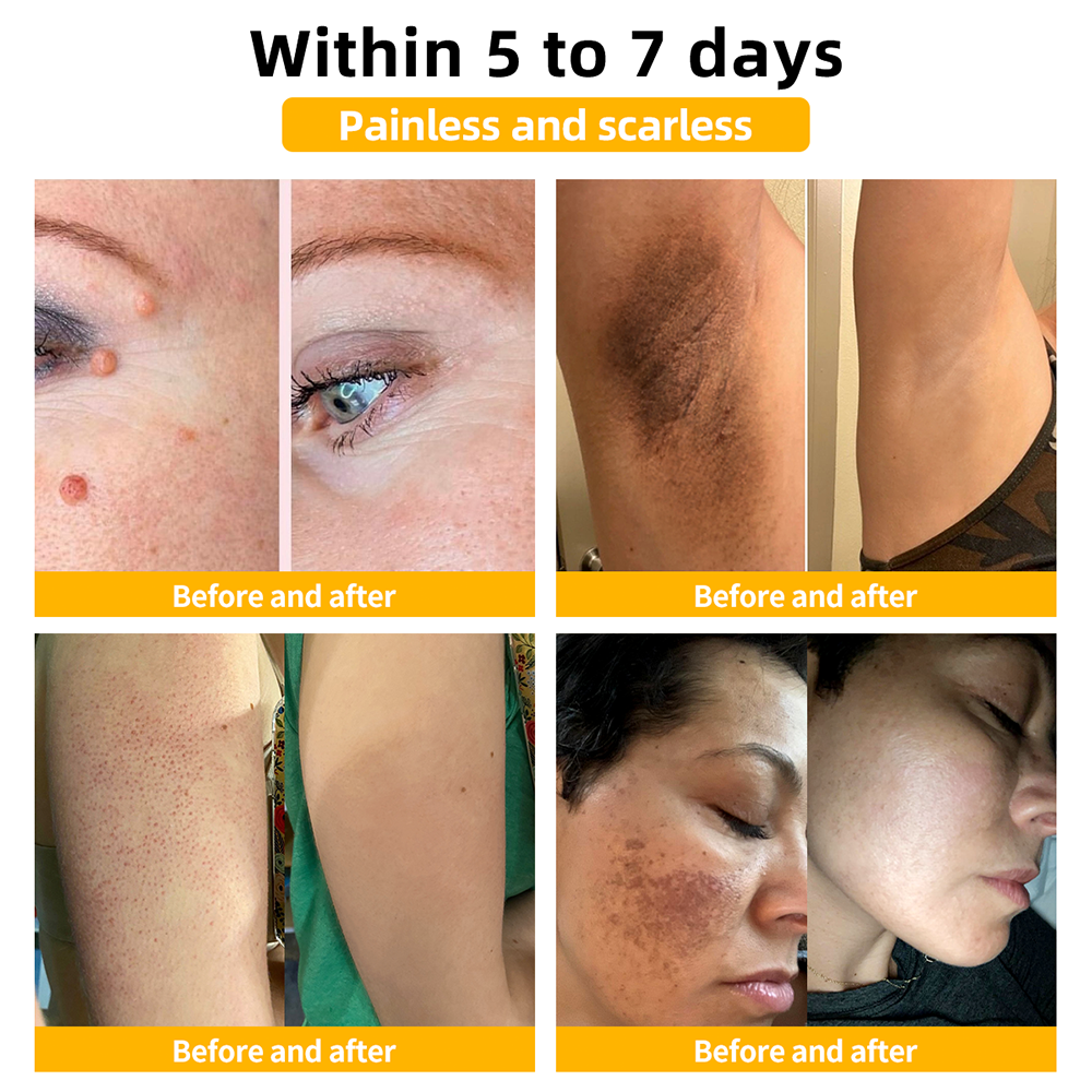 π΅οΈππ’ππππ’β’ Bee Venom Skin Treatment CreamοΌπ΄π΄π· π
πππππππππποΌ