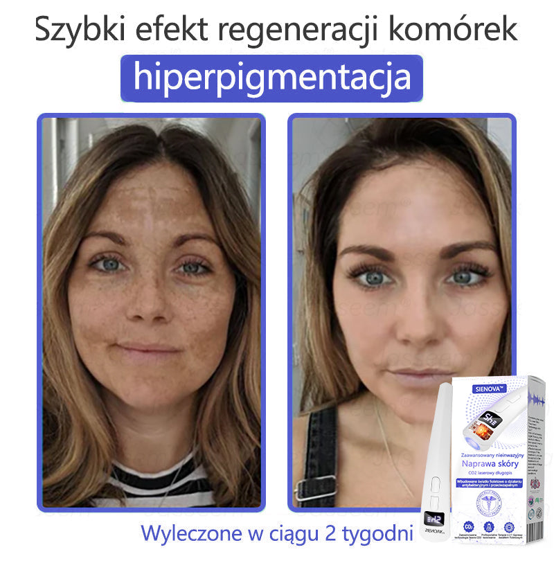 SIE𝖭𝖮𝖵𝖠™ Zaawansowany nieinwazyjny laser CO₂ do naprawy skóry 🎉 (Delikatnie usuwa brodawki, znamiona, plamy starcze i narośla skórne – bez bólu, bez zamieszania!)