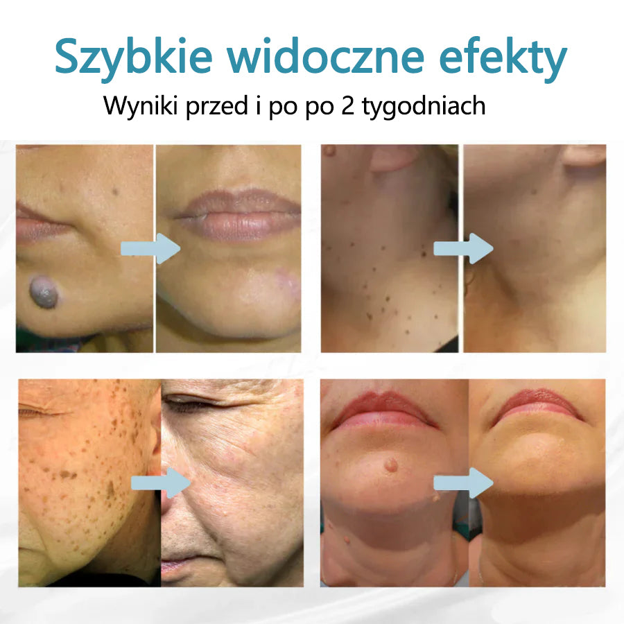 ✨ Bikenda® – Laserowy Długopis CO₂ do Usuwania 🟤 Znamion, 🦠 Brodawek, 🔘 Przebarwień i Innych Niedoskonałości Skóry
