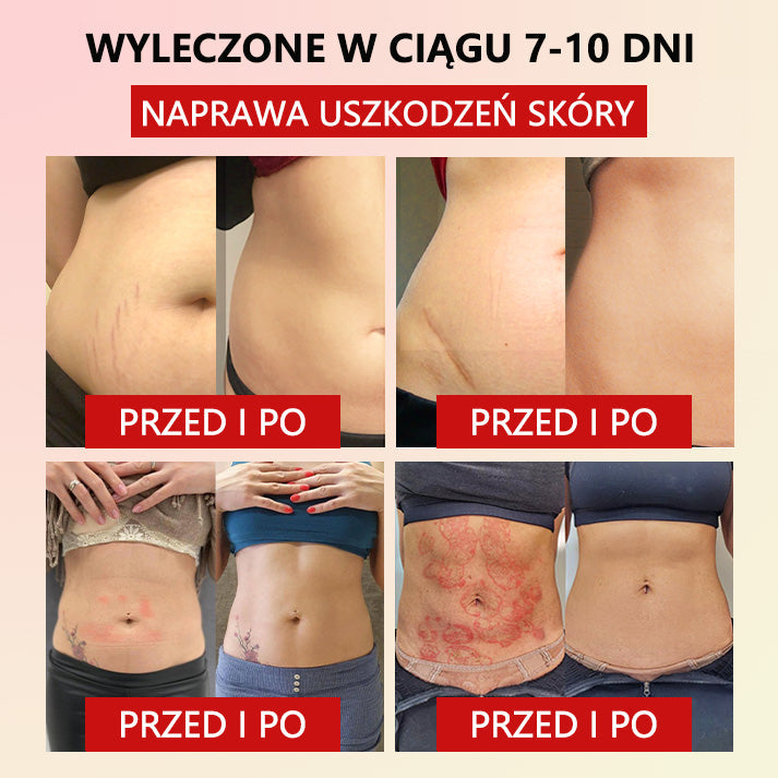 Flouris™ Mikro-wibracyjny Pas Wzmacniający Zioło Piołun do Kształtowania Ciała❤️ (Zalecane przez chirurgów plastycznych)