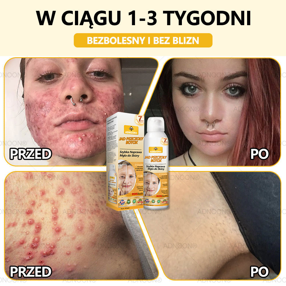 Oficjalny sklep✅: ADNOON® Botox Skin Care Spray, przeciwstarzeniowy, nawilżający, naprawczy, wyrównujący koloryt skóry, leczący trądzik i przebarwienia, usuwający brodawki i znamiona, łagodzący łuszczycę (certyfikowany przez GIS)✨