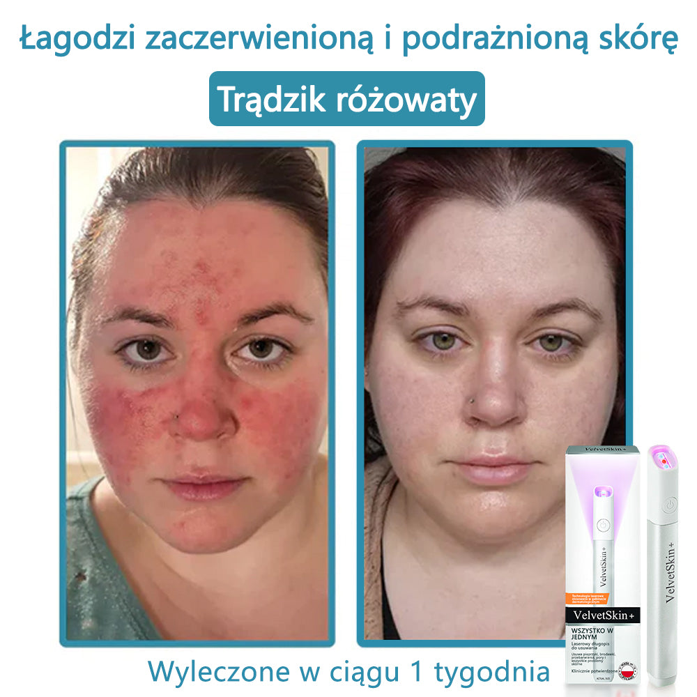✨ Bikenda® – Laserowy Długopis CO₂ do Usuwania 🟤 Znamion, 🦠 Brodawek, 🔘 Przebarwień i Innych Niedoskonałości Skóry