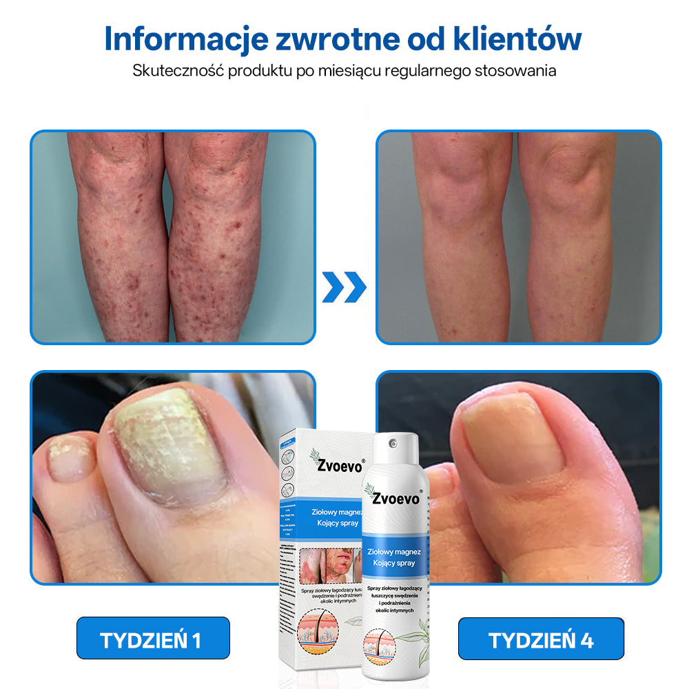 ✅ Oficjalny Sklep: Zvoevo® Magnezowy Ziołowy Spray na Łuszczycę ⚕️ Certyfikowany przez FDA (Łagodzi łuszczycę i egzemę, poprawia infekcje bakteryjne w okolicach intymnych, leczy trądzik i brodawki, łagodzi ból stawów i ból neuropatyczny)