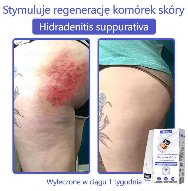 SIE𝖭𝖮𝖵𝖠™ Zaawansowany nieinwazyjny laser CO₂ do naprawy skóry 🎉 (Delikatnie usuwa brodawki, znamiona, plamy starcze i narośla skórne – bez bólu, bez zamieszania!)