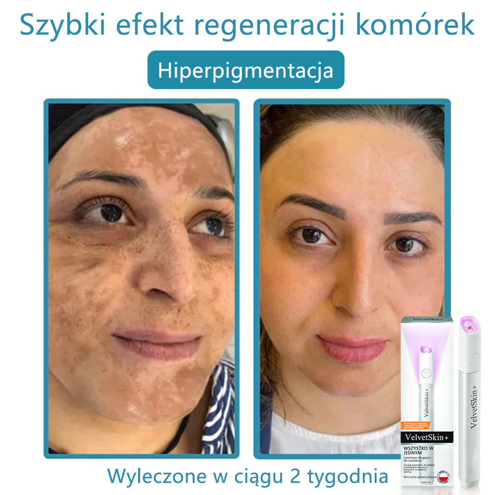 ✨ Bikenda® – Laserowy Długopis CO₂ do Usuwania 🟤 Znamion, 🦠 Brodawek, 🔘 Przebarwień i Innych Niedoskonałości Skóry