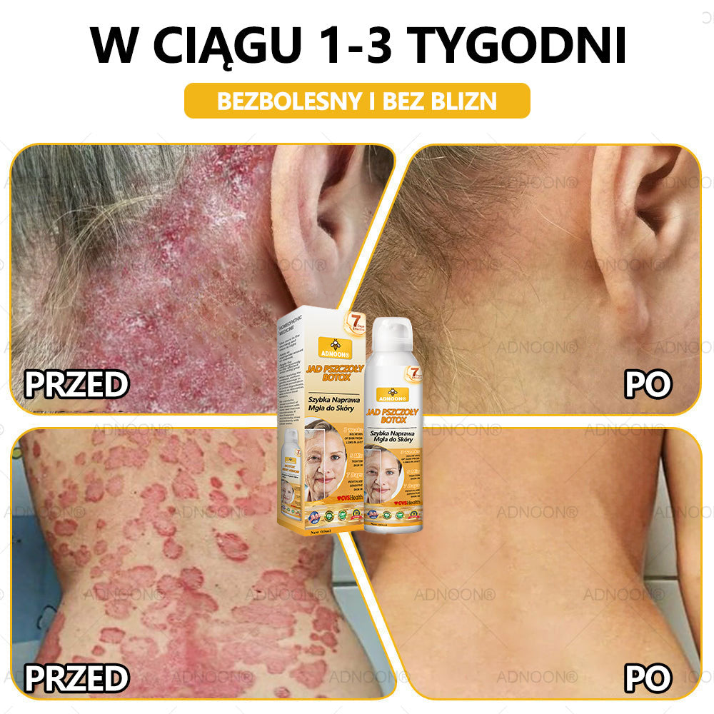 Oficjalny sklep✅: ADNOON® Botox Skin Care Spray, przeciwstarzeniowy, nawilżający, naprawczy, wyrównujący koloryt skóry, leczący trądzik i przebarwienia, usuwający brodawki i znamiona, łagodzący łuszczycę (certyfikowany przez GIS)✨