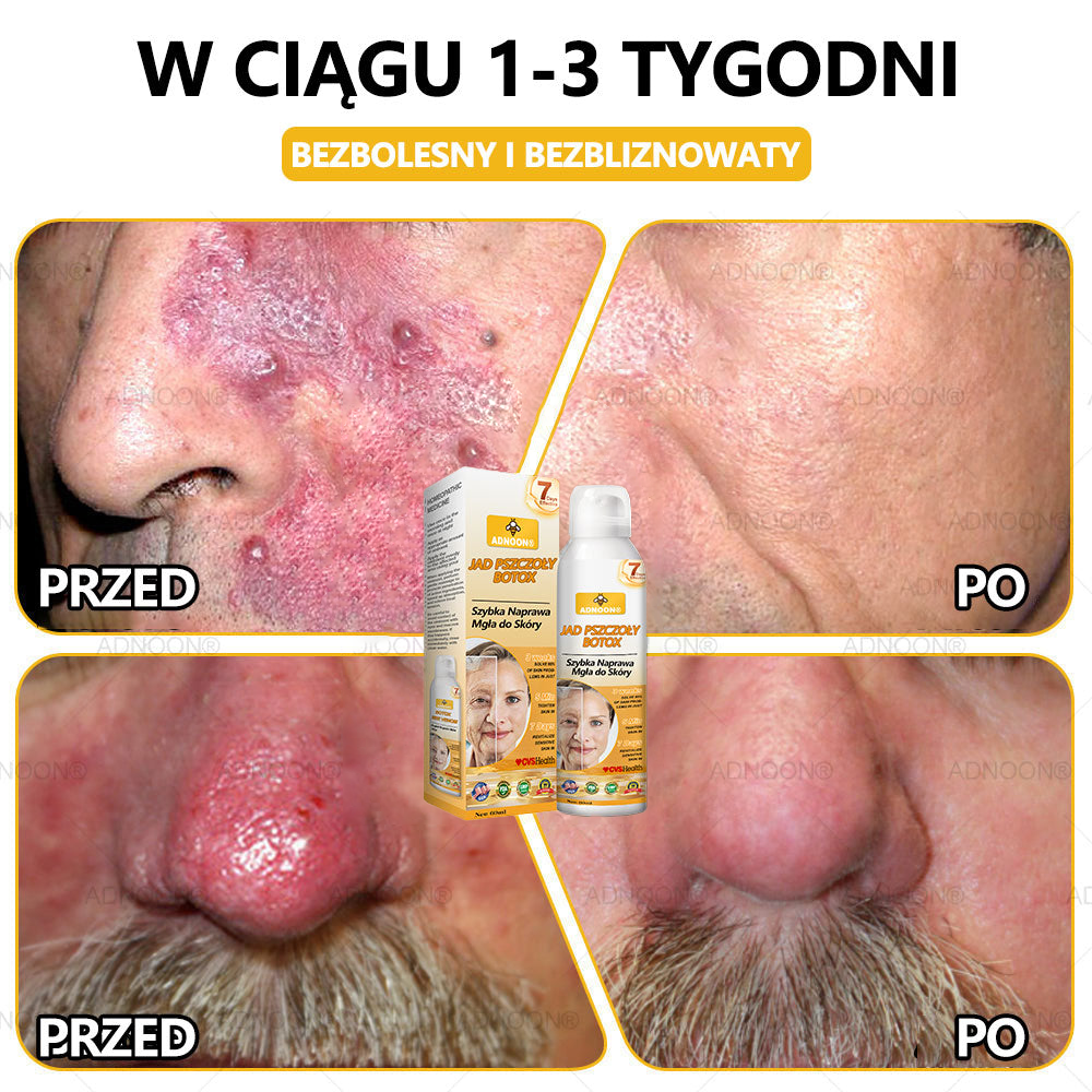 Oficjalny sklep✅: ADNOON® Botox Skin Care Spray, przeciwstarzeniowy, nawilżający, naprawczy, wyrównujący koloryt skóry, leczący trądzik i przebarwienia, usuwający brodawki i znamiona, łagodzący łuszczycę (certyfikowany przez GIS)✨