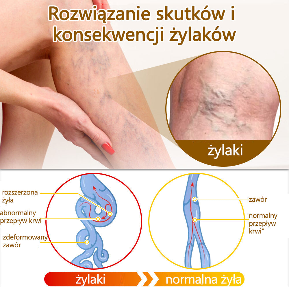 ✅flysmus™ Krem Leczniczy z Jadem Pszczelim🐝: Leczenie egzemy, łuszczycy, trądziku, trądziku różowatego, infekcji grzybiczych, brodawek