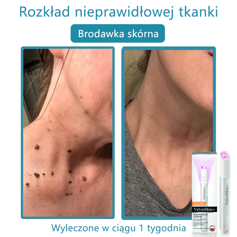 ✨ Bikenda® – Laserowy Długopis CO₂ do Usuwania 🟤 Znamion, 🦠 Brodawek, 🔘 Przebarwień i Innych Niedoskonałości Skóry