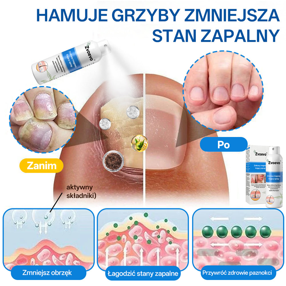 ✅ Oficjalny Sklep: Zvoevo® Magnezowy Ziołowy Spray na Łuszczycę ⚕️ Certyfikowany przez FDA (Łagodzi łuszczycę i egzemę, poprawia infekcje bakteryjne w okolicach intymnych, leczy trądzik i brodawki, łagodzi ból stawów i ból neuropatyczny)