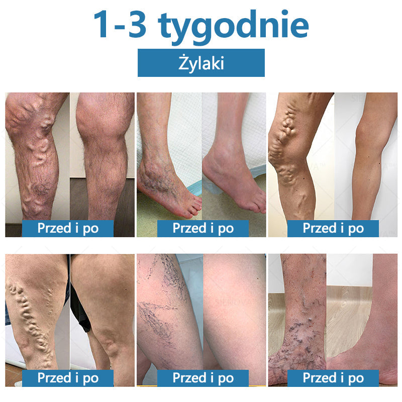 SIE𝖭𝖮𝖵𝖠™💎 Przenośne urządzenie do drenażu limfatycznego i relaksacji stawów👨⚕️Oryginalna terapia 2 w 1 | URPL✅ Polecane