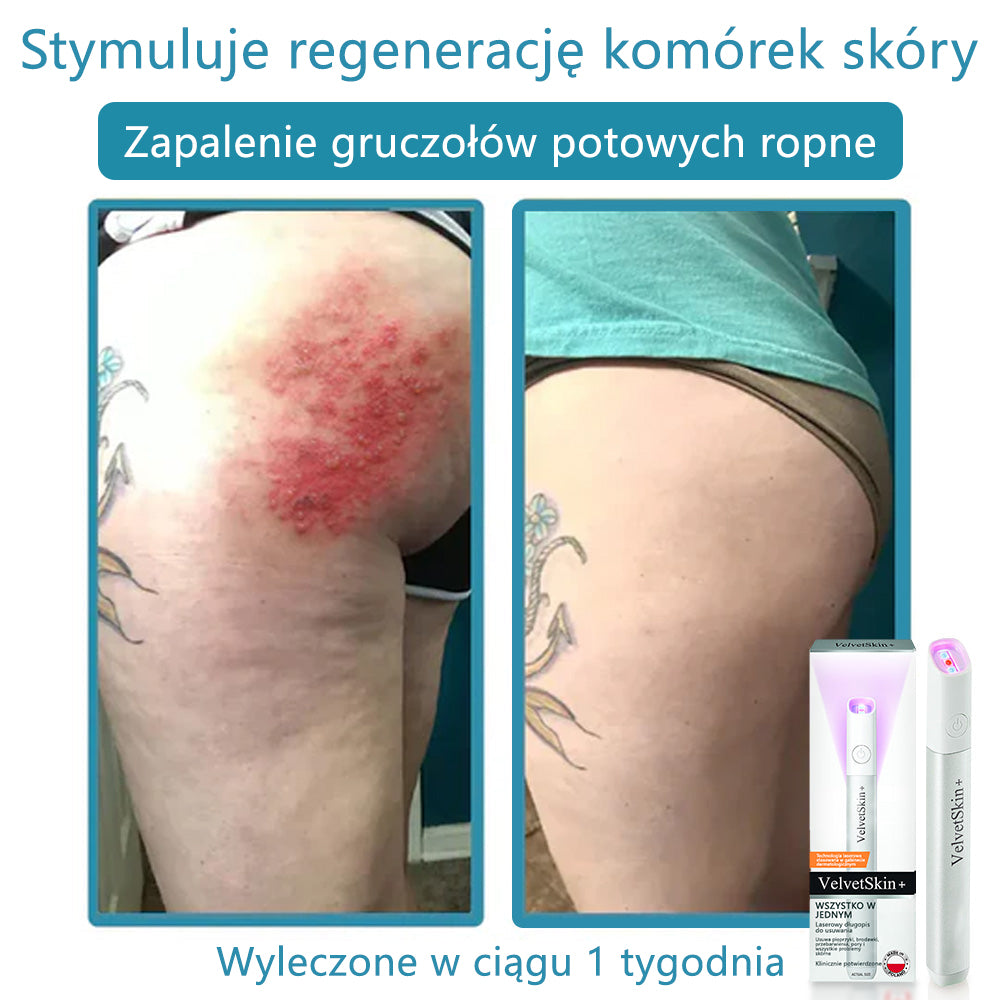 ✨ Bikenda® – Laserowy Długopis CO₂ do Usuwania 🟤 Znamion, 🦠 Brodawek, 🔘 Przebarwień i Innych Niedoskonałości Skóry