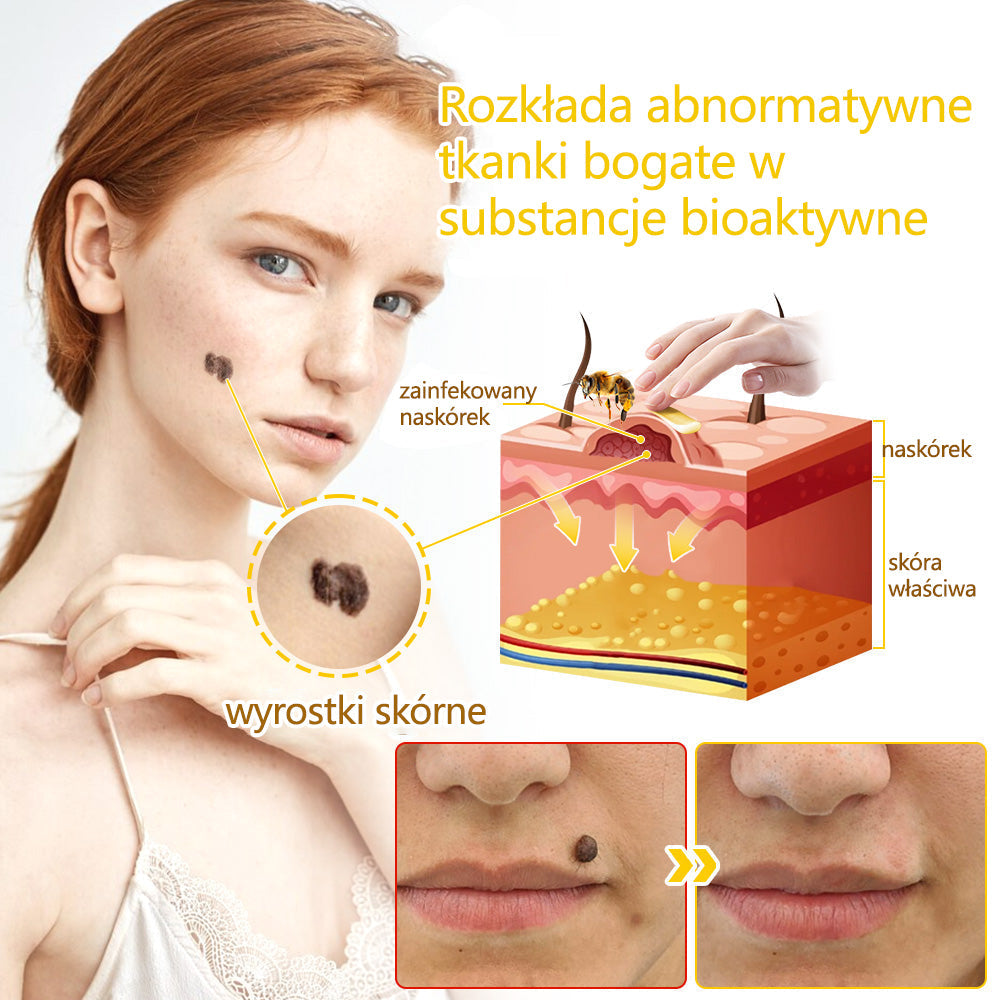 ✅flysmus™ Krem Leczniczy z Jadem Pszczelim🐝: Leczenie egzemy, łuszczycy, trądziku, trądziku różowatego, infekcji grzybiczych, brodawek