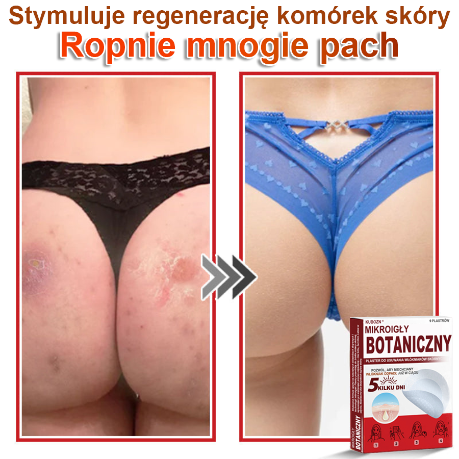 KUBOZN® – 🌿 Mikroigłowy Botaniczny Plaster 🌿 Skuteczne Usuwanie Narośli Skórnych | 💎 Naturalna Formuła