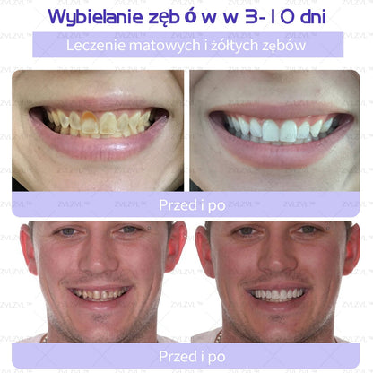Mineralny proszek do odbudowy zębów ZVLZVL™ 🦷(polecany przez PTS)(👨🏻‍⚕️Oferta ograniczona czasowo — nie przegap jej👨🏻‍⚕️)