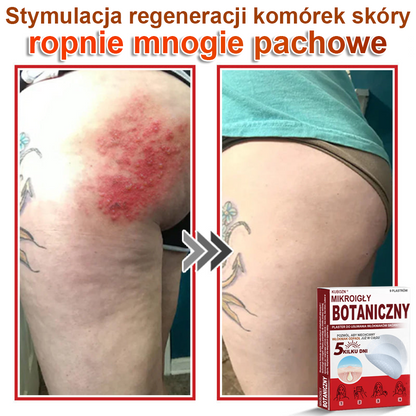 KUBOZN® – 🌿 Mikroigłowy Botaniczny Plaster 🌿 Skuteczne Usuwanie Narośli Skórnych | 💎 Naturalna Formuła