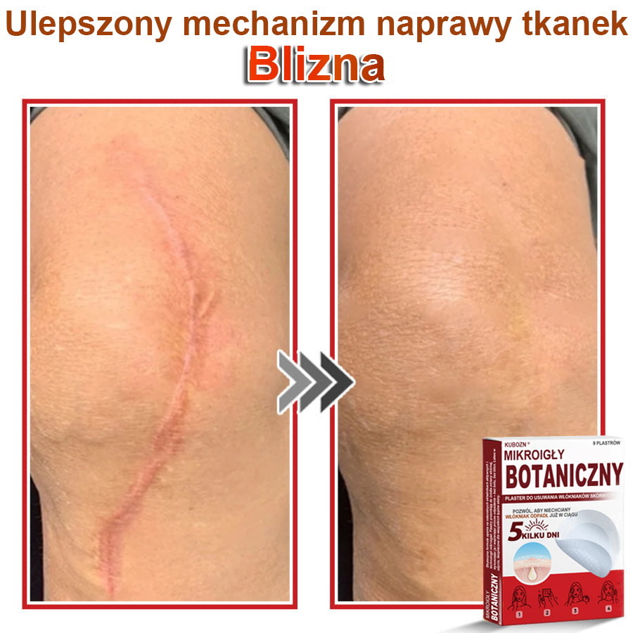 KUBOZN® – 🌿 Mikroigłowy Botaniczny Plaster 🌿 Skuteczne Usuwanie Narośli Skórnych | 💎 Naturalna Formuła