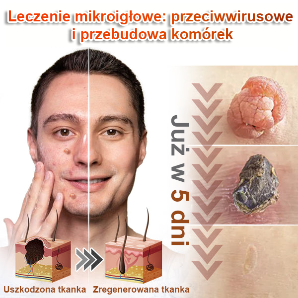 KUBOZN® – 🌿 Mikroigłowy Botaniczny Plaster 🌿 Skuteczne Usuwanie Narośli Skórnych | 💎 Naturalna Formuła