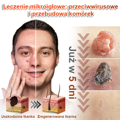 KUBOZN® – 🌿 Mikroigłowy Botaniczny Plaster 🌿 Skuteczne Usuwanie Narośli Skórnych | 💎 Naturalna Formuła
