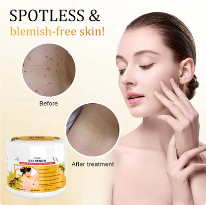 🍀🐝[👑Official Brand Store👑] Cvreoz™ Bee Venom Mole and Wart Treatment Cream(👨‍⚕AAD RECOMMENDS)
