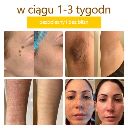 ✅flysmus™ Krem Leczniczy z Jadem Pszczelim🐝: Leczenie egzemy, łuszczycy, trądziku, trądziku różowatego, infekcji grzybiczych, brodawek
