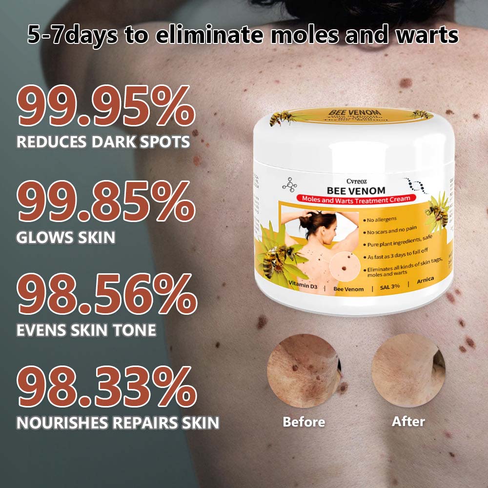 🍀🐝[👑Official Brand Store👑] Cvreoz™ Bee Venom Mole and Wart Treatment Cream(👨‍⚕AAD RECOMMENDS)