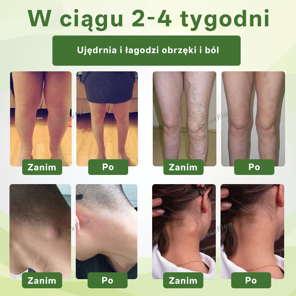 [ Efekty już w 7 dni ]👨‍⚕️ Croaie® Krem na Obrzęki i Żylaki (Certyfikat GMP UE • Opracowany na obrzęki, żylaki i słabe krążenie krwi 🦵)