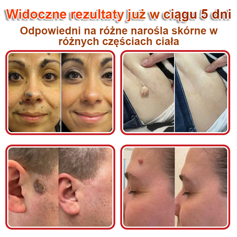 KUBOZN® – 🌿 Mikroigłowy Botaniczny Plaster 🌿 Skuteczne Usuwanie Narośli Skórnych | 💎 Naturalna Formuła