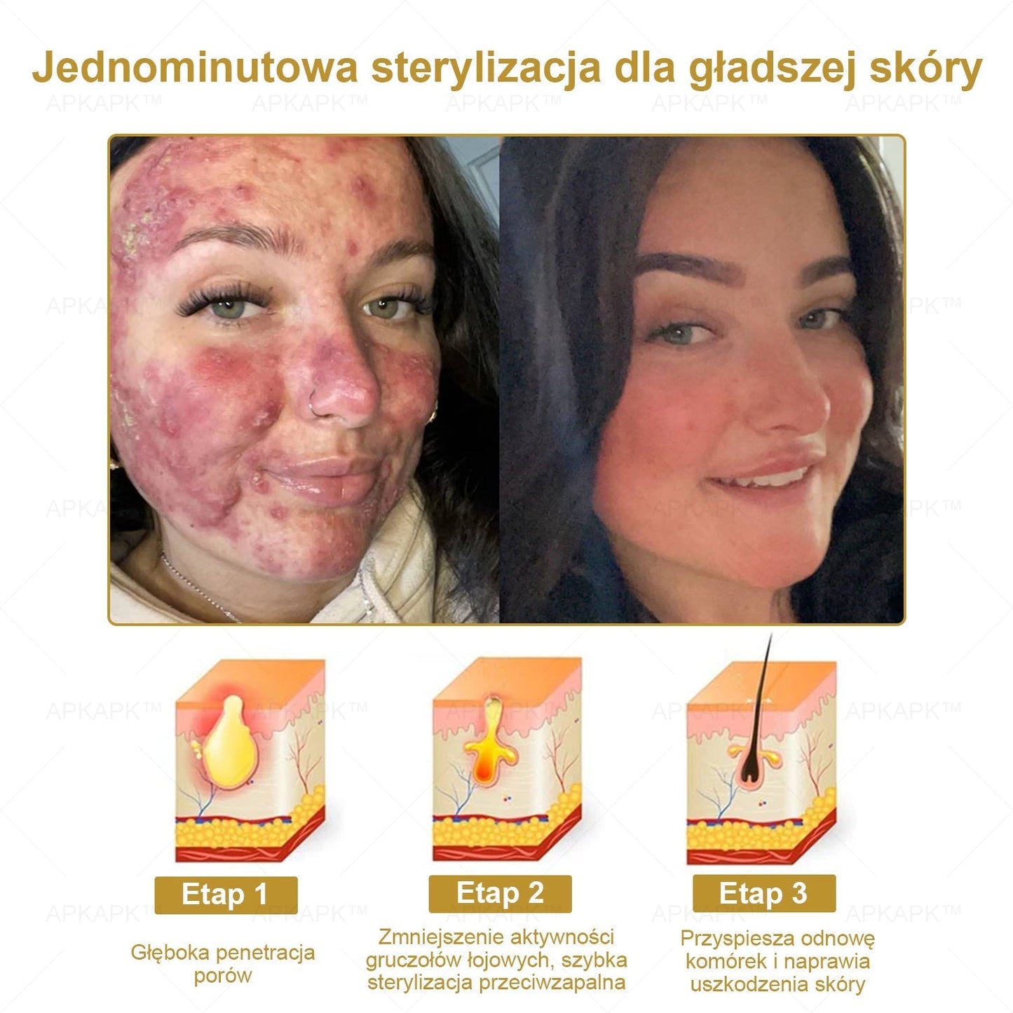 APKAPK™ Skuteczny krem do kompleksowej pielęgnacji skóry, 🧑‍⚕️🧑‍⚕️🧑‍⚕️zatwierdzony przez Polskie Towarzystwo Dermatologiczne (PTD) oraz  – Państwowy Zakład Higieny (PZH).