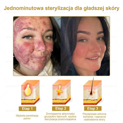 APKAPK™ Skuteczny krem do kompleksowej pielęgnacji skóry, 🧑‍⚕️🧑‍⚕️🧑‍⚕️zatwierdzony przez Polskie Towarzystwo Dermatologiczne (PTD) oraz  – Państwowy Zakład Higieny (PZH).