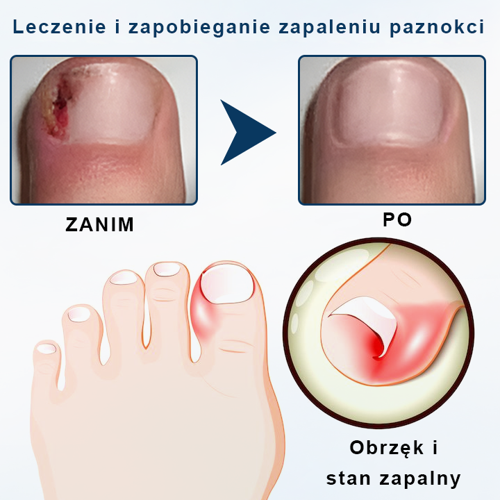 ✨ Timilk® ✨ – 🌿 Ziołowy Spray Przeciwgrzybiczy do Paznokci i Skóry 🦶
