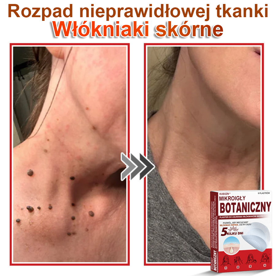 KUBOZN® – 🌿 Mikroigłowy Botaniczny Plaster 🌿 Skuteczne Usuwanie Narośli Skórnych | 💎 Naturalna Formuła