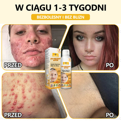 Oficjalny sklep✅: ADNOON® Botox Skin Care Spray, przeciwstarzeniowy, nawilżający, naprawczy, wyrównujący koloryt skóry, leczący trądzik i przebarwienia, usuwający brodawki i znamiona, łagodzący łuszczycę (certyfikowany przez GIS)✨