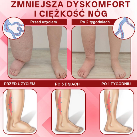 [ Efekty już w 7 dni ]👨‍⚕️ Croaie® Krem na Obrzęki i Żylaki (Certyfikat GMP UE • Opracowany na obrzęki, żylaki i słabe krążenie krwi 🦵)
