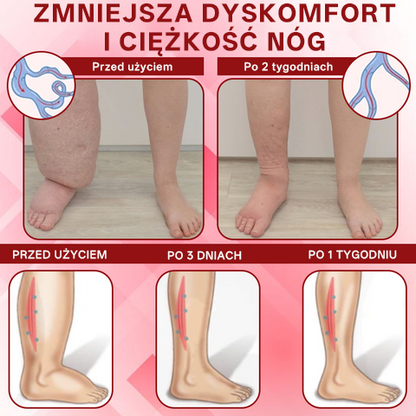 [ Efekty już w 7 dni ]👨‍⚕️ Croaie® Krem na Obrzęki i Żylaki (Certyfikat GMP UE • Opracowany na obrzęki, żylaki i słabe krążenie krwi 🦵)
