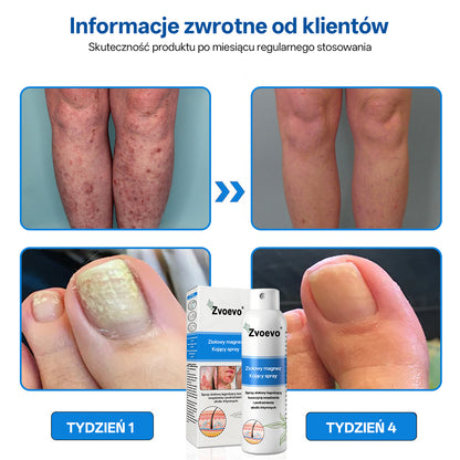 ✅ Oficjalny Sklep: Zvoevo® Magnezowy Ziołowy Spray na Łuszczycę ⚕️ Certyfikowany przez FDA (Łagodzi łuszczycę i egzemę, poprawia infekcje bakteryjne w okolicach intymnych, leczy trądzik i brodawki, łagodzi ból stawów i ból neuropatyczny)