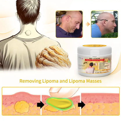 👨‍⚕🐝[👑Official Brand Store👑] Cvreoz™ Bee Venom Lipoma Removal Cream