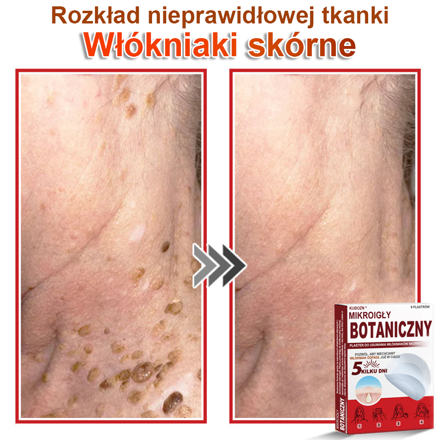 KUBOZN® – 🌿 Mikroigłowy Botaniczny Plaster 🌿 Skuteczne Usuwanie Narośli Skórnych | 💎 Naturalna Formuła