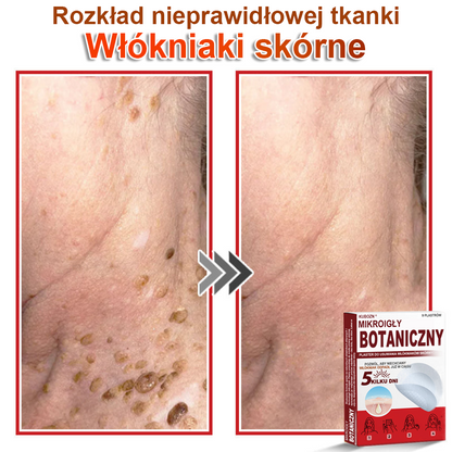 KUBOZN® – 🌿 Mikroigłowy Botaniczny Plaster 🌿 Skuteczne Usuwanie Narośli Skórnych | 💎 Naturalna Formuła